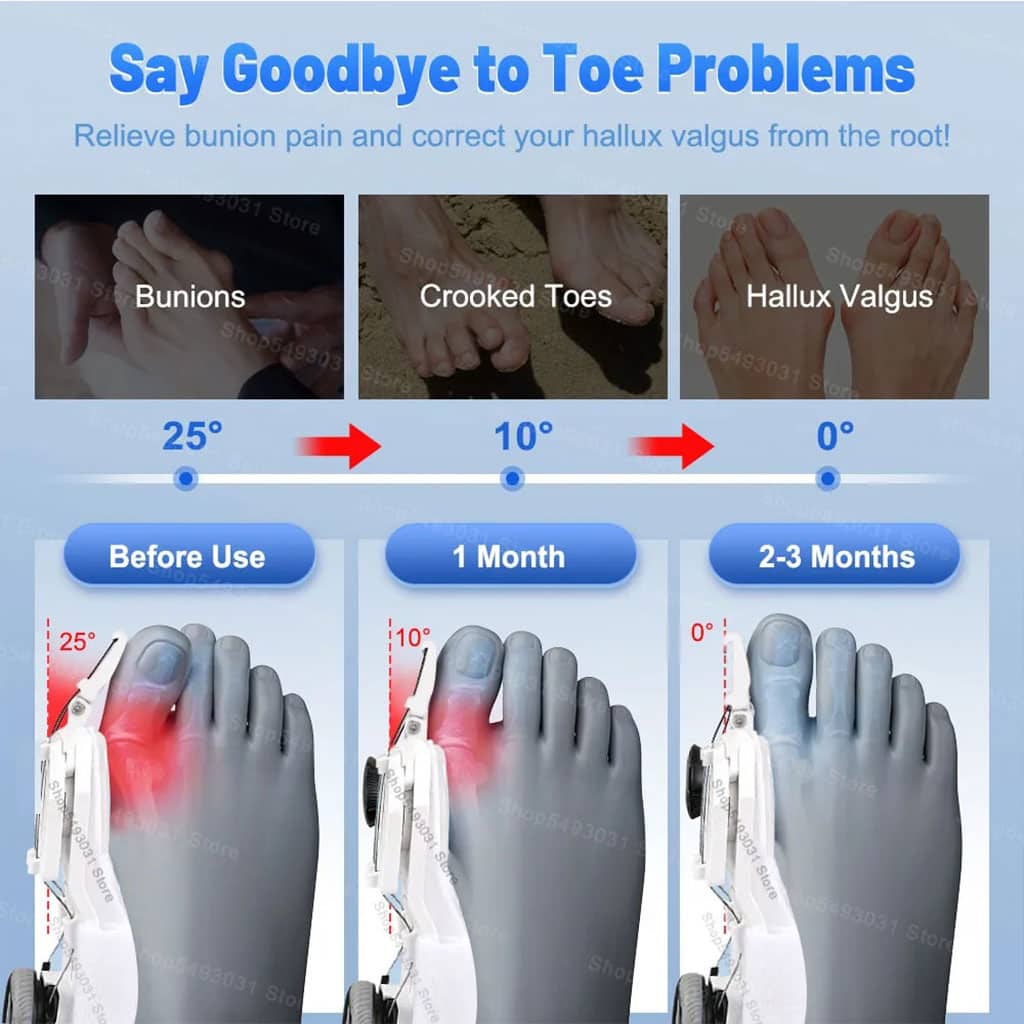 Correcteur Hallux Valgus pour Femme et Homme avec Molette Réglable – مصحح وضعية القدم - Soins et Beauté - صورة 4