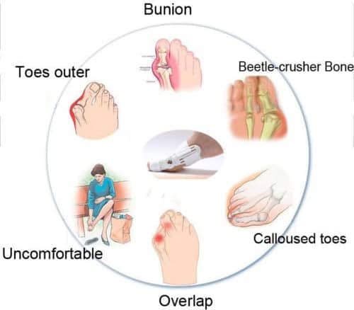 Correcteur Et Ort-hèse De Pied – Blanc - Divers - صورة 6