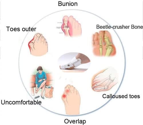 Correcteur Et Ort-hèse De Pied – Blanc - Divers - صورة 6